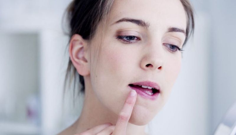 Home Remedies To Beat Chapped Lips In Winter