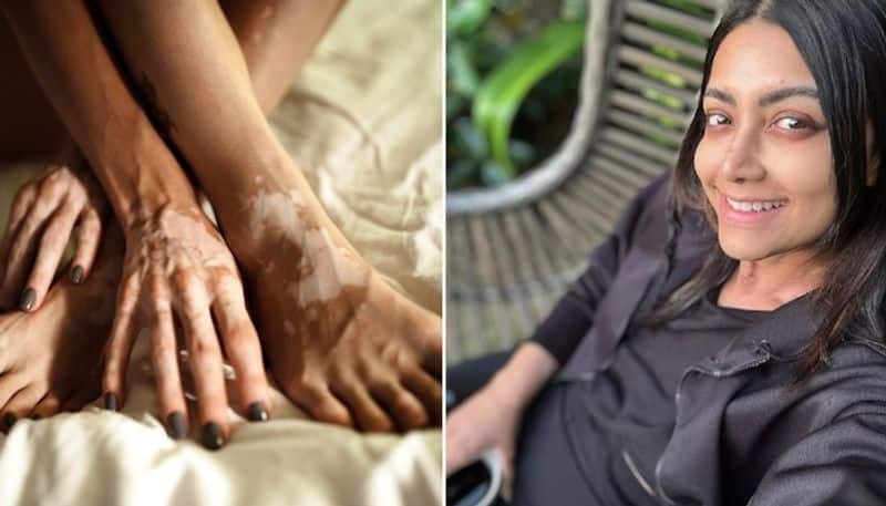 What Is Vitiligo? Mamta Mohandas experiences skin color loss; know the symptoms, causes and more RBA