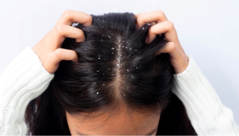 home remedies to cure dandruff 