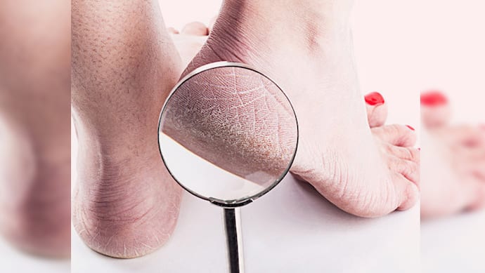 5 home remedies For Cracked Heels