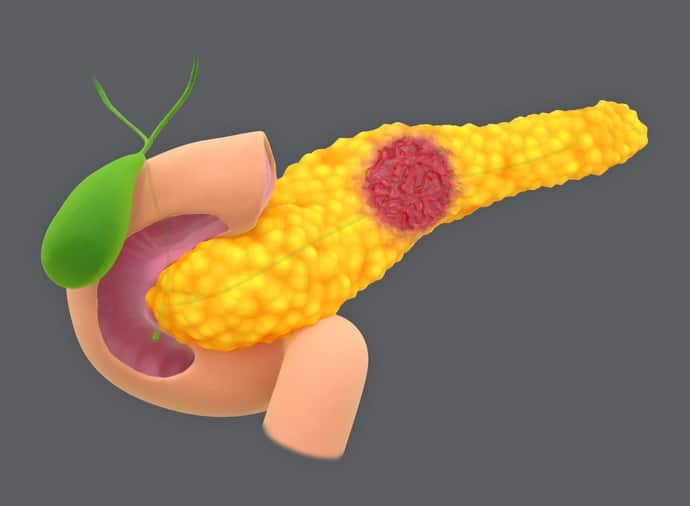 Bile Duct Cancer