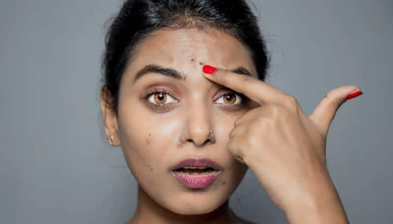 home remedies to get rid of dark spots