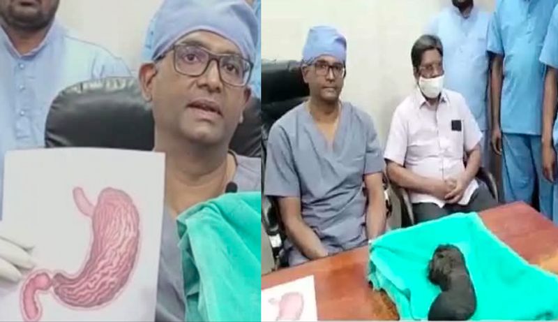 Andhra Pradesh, More than a kilo of hair lump removed from a girls stomach Vin