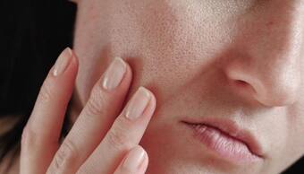 Beauty Tips: పొడి చర్మంతో ఇబ్బంది పడుతున్నారా.. ఆయుర్వేద చిట్కాలతో ఉపశమనం పొందండి!