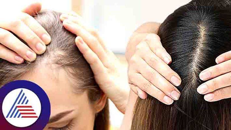 Best Home Remedies For Alopecia Areata  