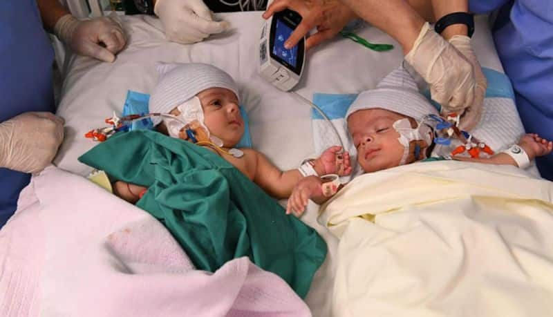 UN declares November 24 as World Conjoined Twins Day in the initiative of Saudi Arabia