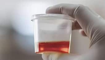 Health Tips: మీ మూత్రం రంగు మారుతుందా.. జాగ్రత్త, ఇది మీకు శరీరం పంపించే డేంజర్ బెల్!