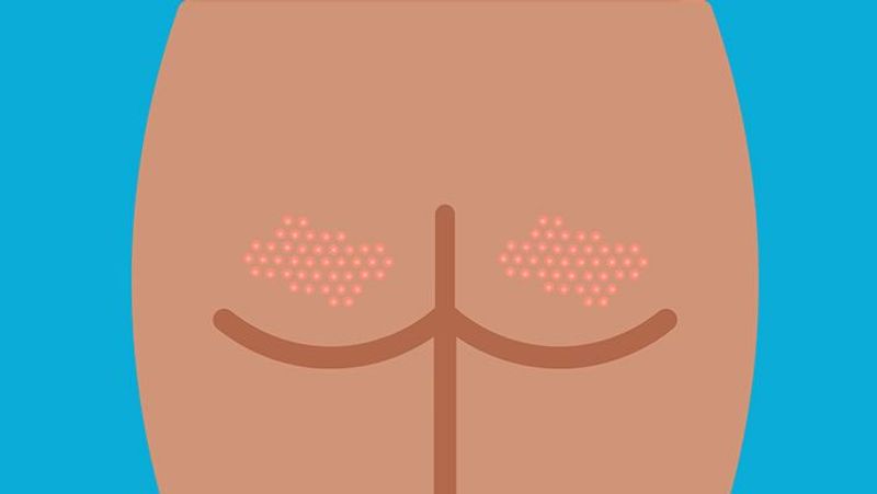 Following are some butt acne causes and treatments