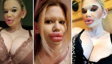 Bizarre: Woman who spent Rs 8 lakh to have 'world's biggest lips' reveals latest beauty goal
