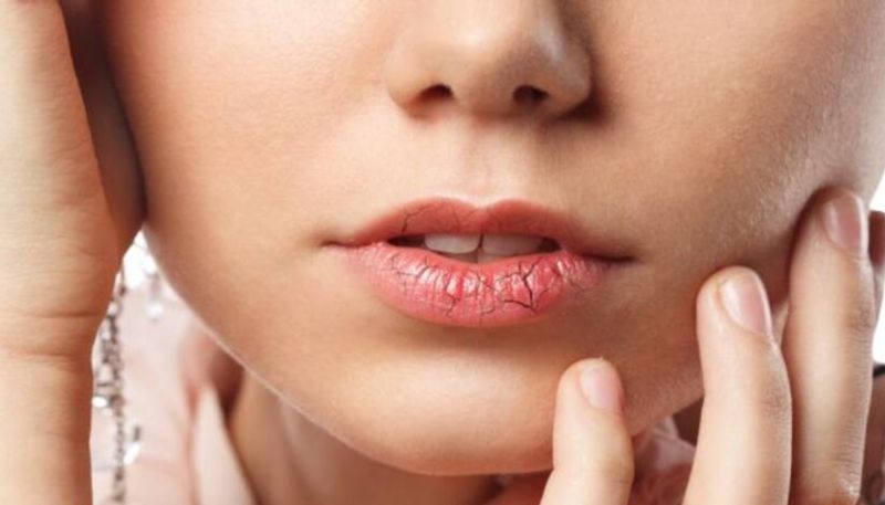 home remedies to get rid of chapped lips azn 