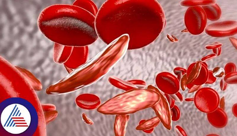 Bangalore startup kit for detection of sickle cell anemia Vin