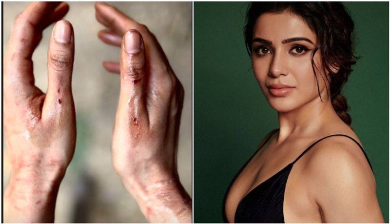 Actress Samantha shares a photo of injured hand sgk