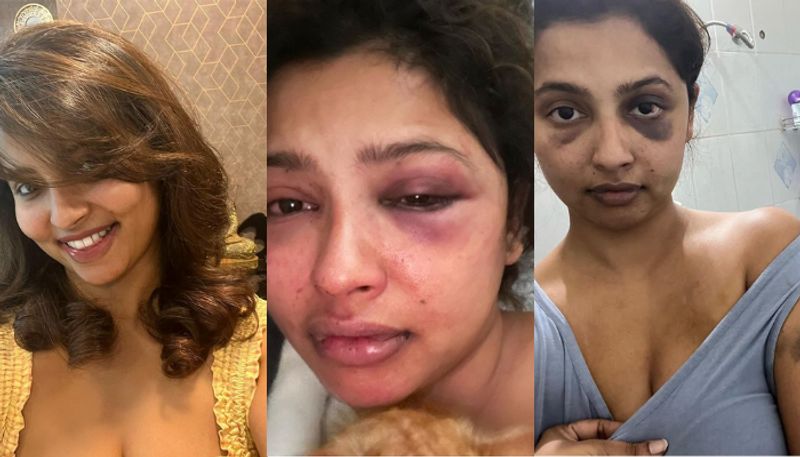 Malayalam actress Anicka Vikhraman claims ex-boyfriend Anoop Pillai assaulted her; pictures go viral RBA