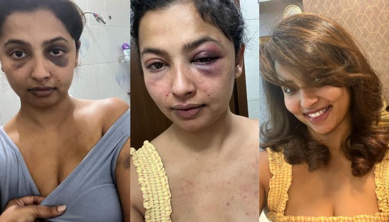 Actress Anicka Vijay Vikraman shares photos of her Ex Boyfriend Beat Her sgk