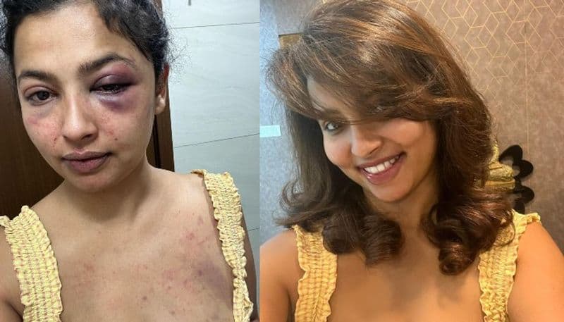 Malayalam Actress anicka attacked by her ex boyfriend 