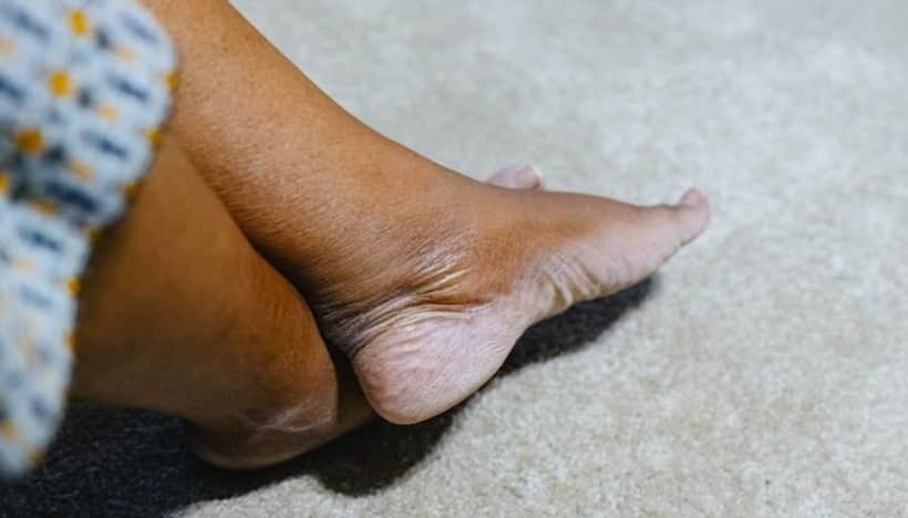 Skincare tips: 6 ways to keep your heels crack free and healthy this summer