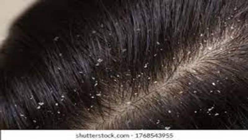 Hair Mask Recipes To Get Rid Of Dandruff Naturally At Home ram