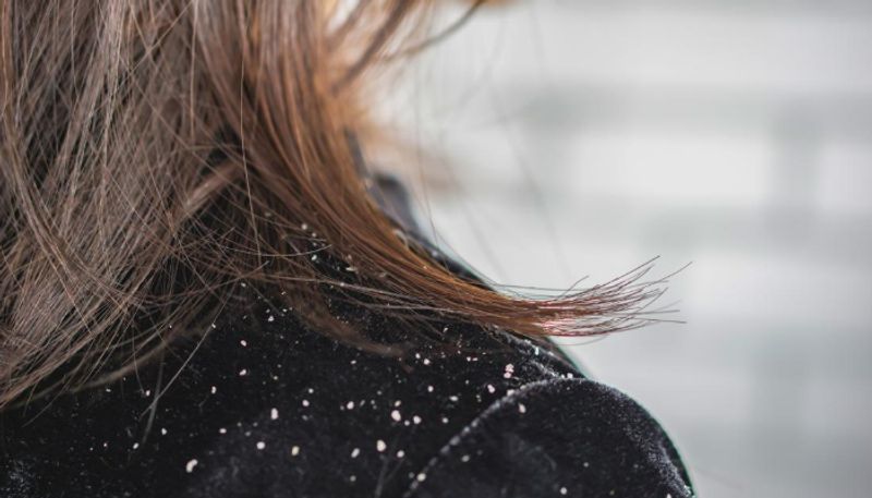 hair packs to get rid of dandruff and hair fall azn 