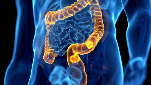 Colon cancer