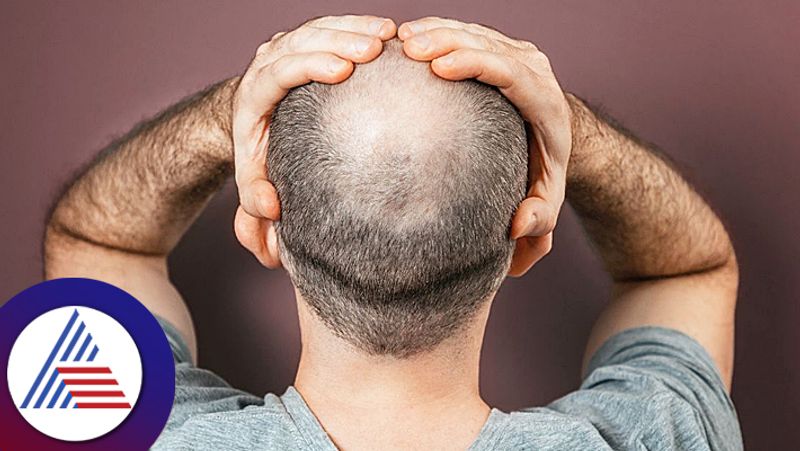 Men With Such Fingers Are More At Risk Of Becoming Bald Research Claims