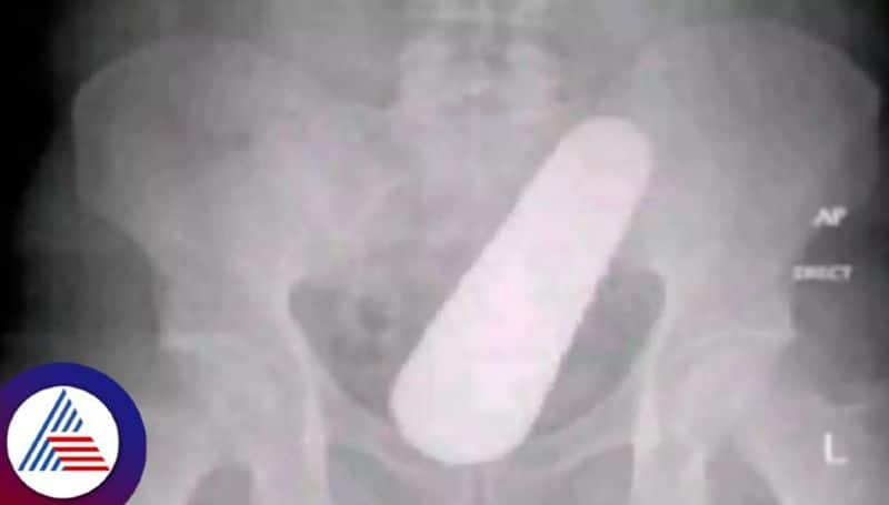 Man With Cucumber Stuck In His Behind Says, It Grew Inside Me As I Ate So Many Vin