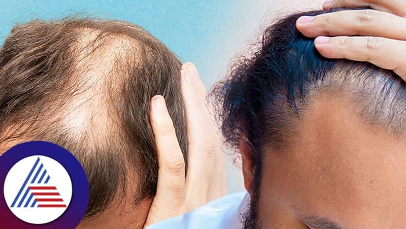 Men Hair fall problems