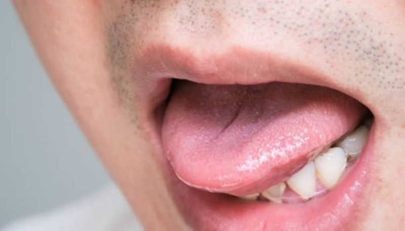 beware of these symptoms on tongue and do a vitamin test hyp 