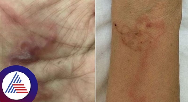 Parasites found under Vietnam womans skin after she ate raw blood pudding Vin