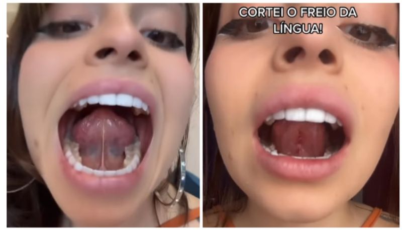 Young woman removed her lingual frenulum for better kiss bkg