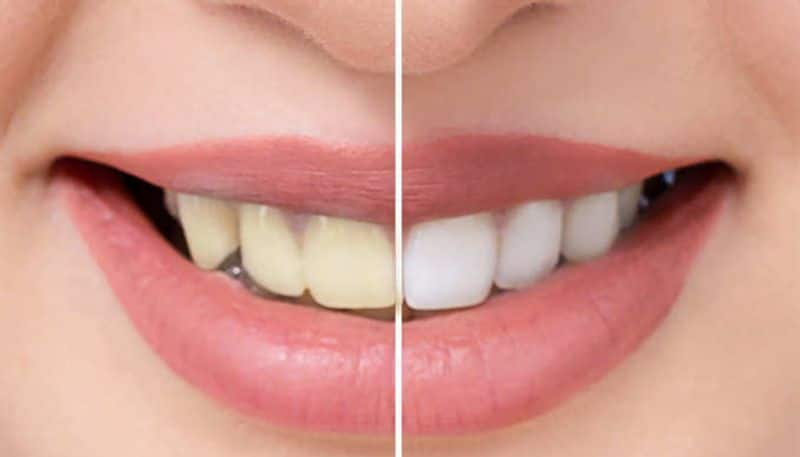 6 best natural way to remove plaque from teeth at home in tamil mks