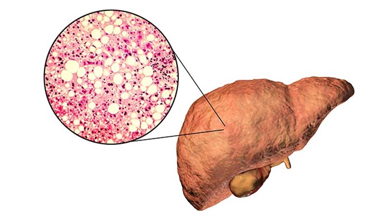 Can a skinny person suffer from fatty liver disease? Read this NOW RBA