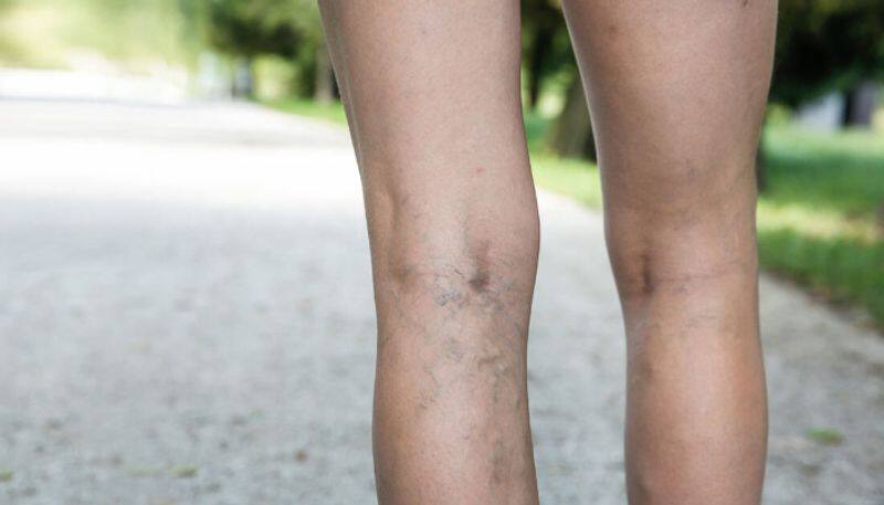 varicose veins causes symptoms and treatment in tamil mks