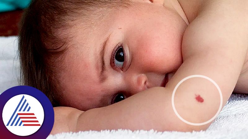 What Are The Causes Of Birthmarks In Infant 