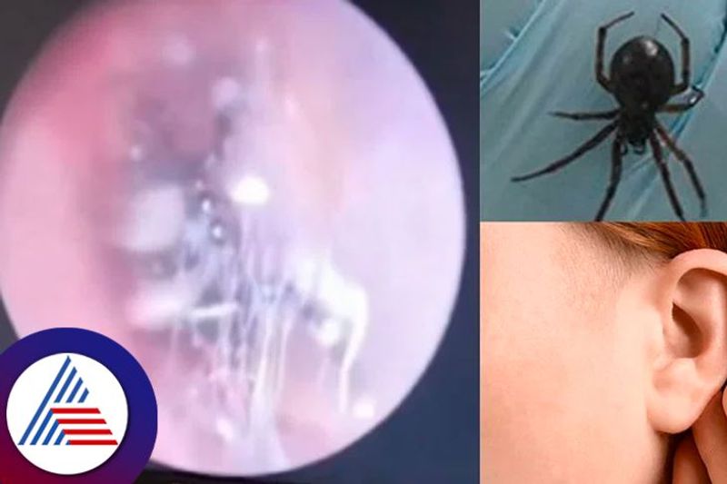 Chinese Woman Suffering From Ear Pain Finds Spider Nesting Inside Vin