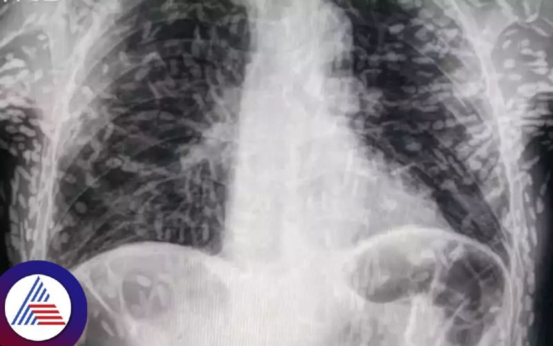 Man Goes To Hospital With Cough And Discovers He is Swarming With Tapeworms Vin