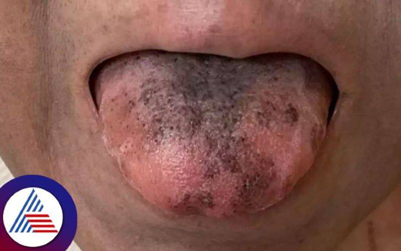 Womans Tongue Turns Black And Hairy After Rare Reaction To Medicine Vin