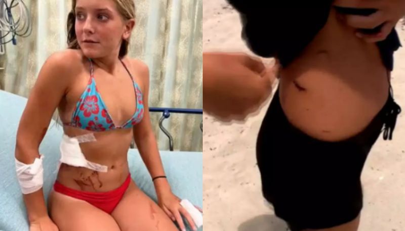 Brave Girl Survives After Punching 6 Foot Bull Shark That Bit Her azn