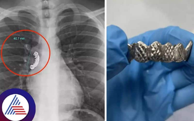 Man 22, gets Dentures stuck in lung after Swallowing them by accident Vin