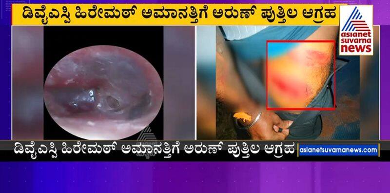 damage to the victims ears of police assault case at puttur in mangaluru gvd