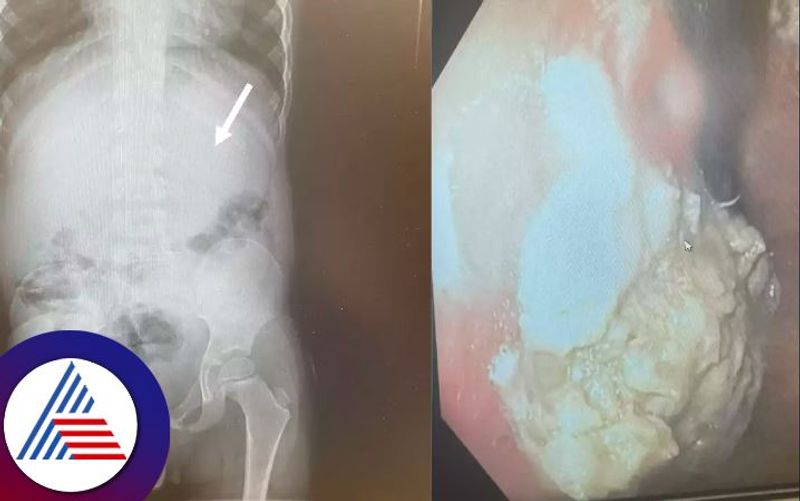 OId Boy In US Undergoes Emergency Operation After Swallowing 40 Pieces Of Gum Vin