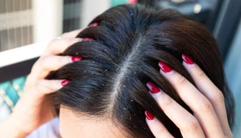 seven Home remedies for dandruff azn