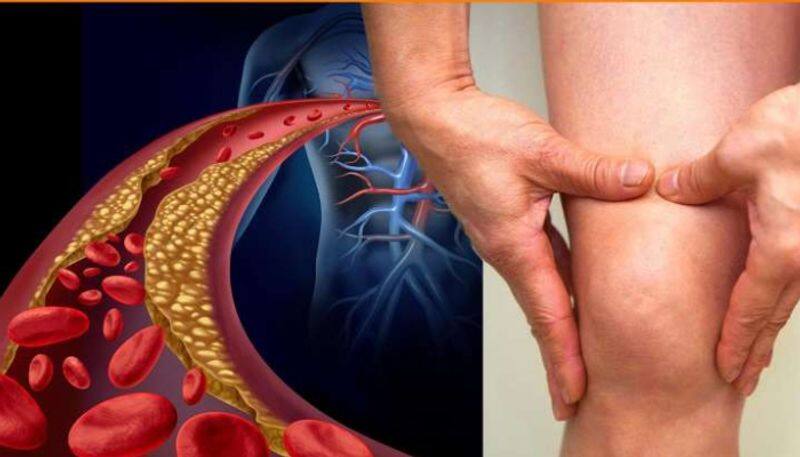 How to find cholesterol increasing in body, legs will tell you