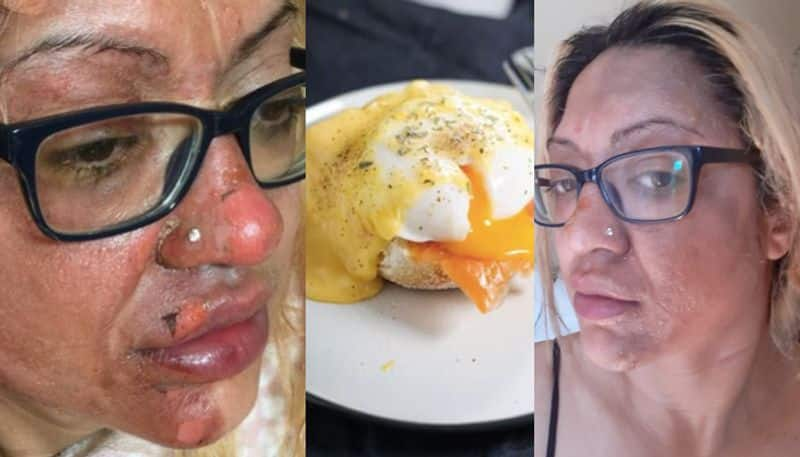 Microwave Hack To Cook Eggs Woman Injures And Burns Her Face azn