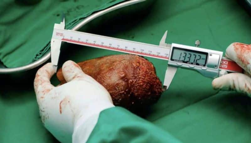 worlds largest kidney stone removed in srilanka etj