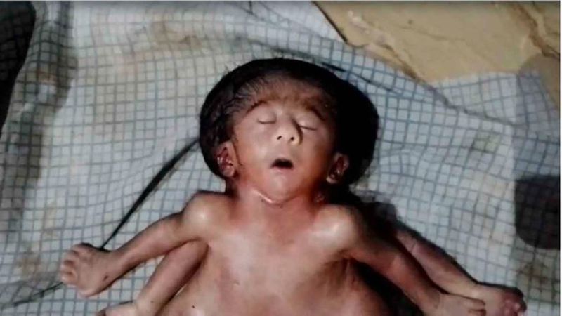 A rare baby girl born in Bihar's Chhapra A child with 4 arms four legs and two hearts akb