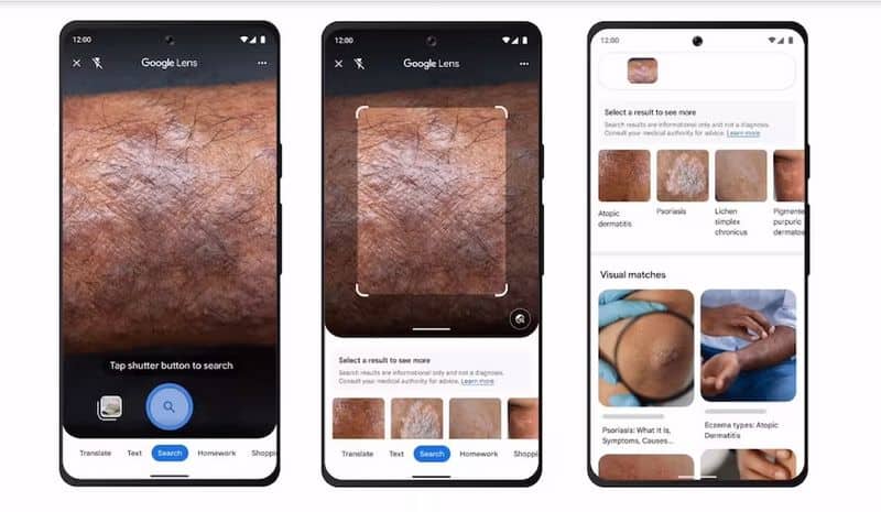 Google Lens Updated With Support for Skin Condition Detection vvk