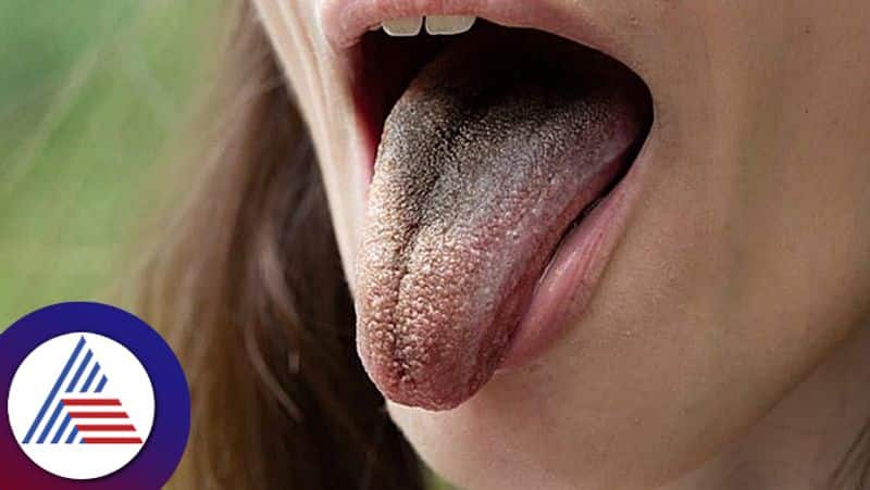 Reasons for tongue turning into black color pav