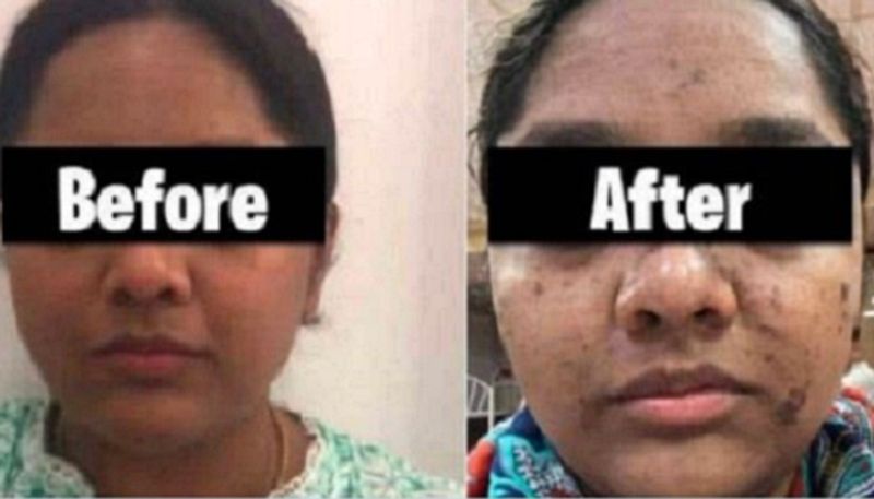 mumbai woman faces skin burn after facial massage worth rs 17 500 fir against salon ash