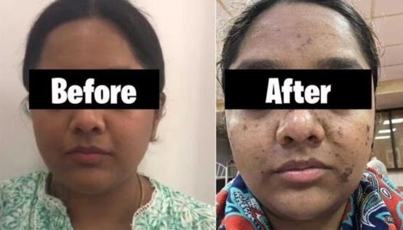 womans face burnt after doing facial hyp 