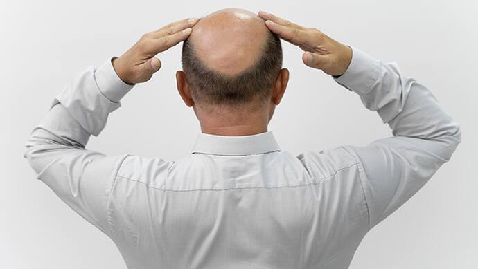 Hair loss in Male